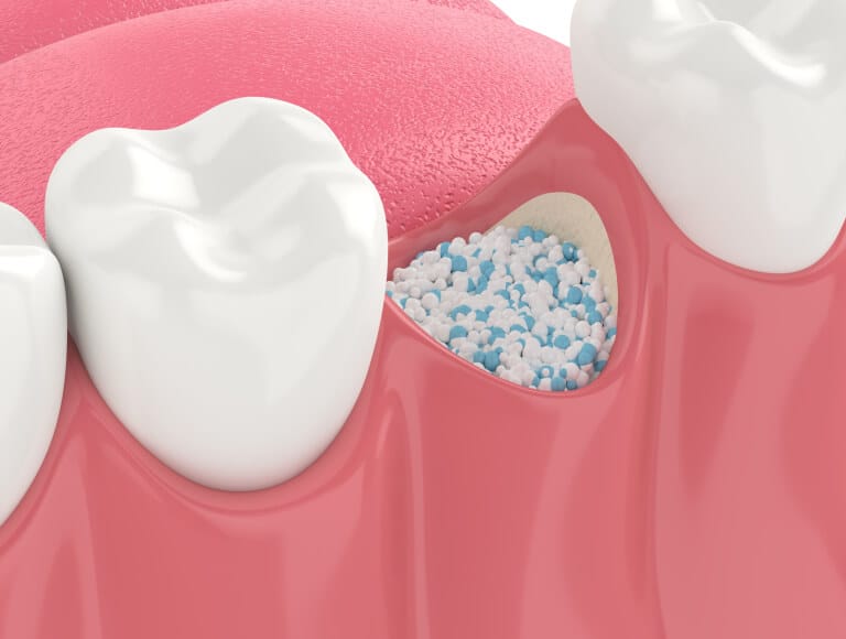 Is Bone Grafting the Right Choice for You?