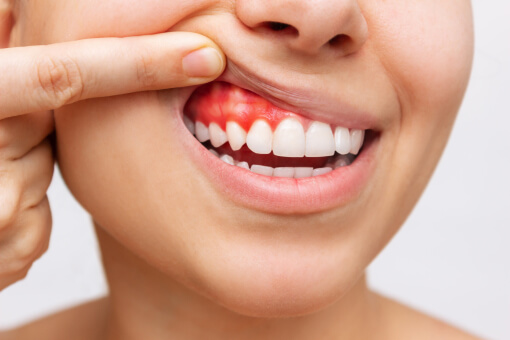 Gum Disease Treatment