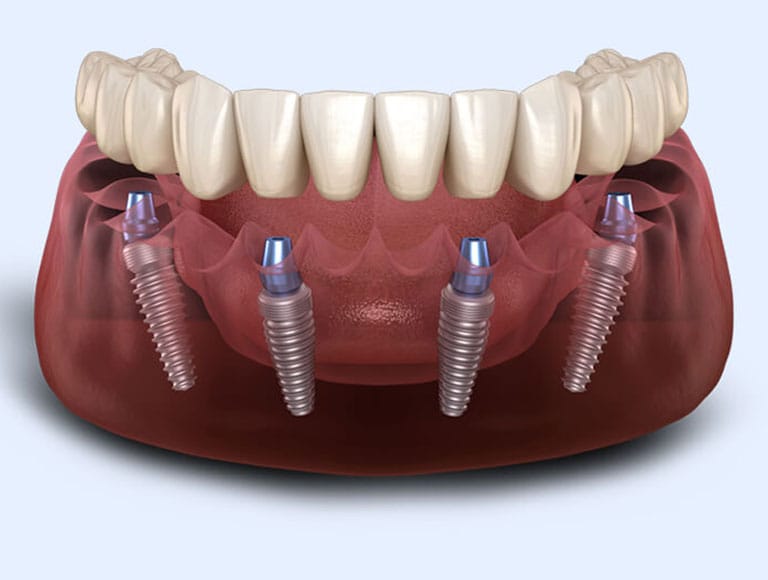 Revolutionary All-On-4® Technology