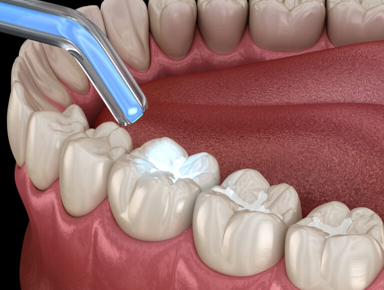 Are Dental Fillings the Right Choice for You?