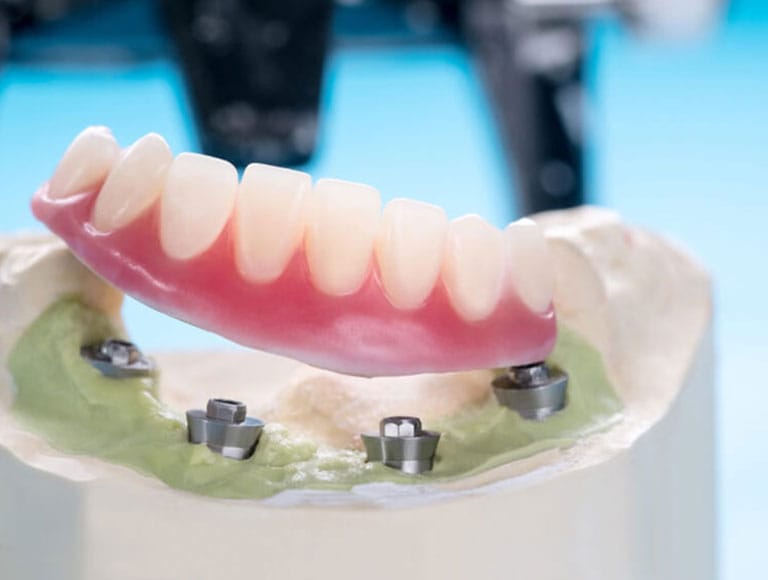 Implant-Supported Dentures