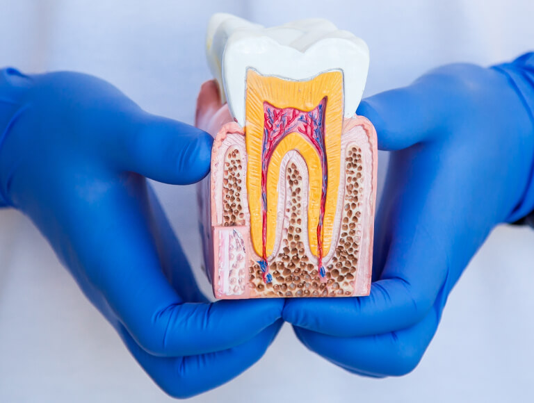Root Canal Therapy