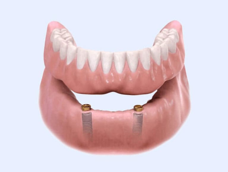 Discover Personalized Dental Implant Solutions